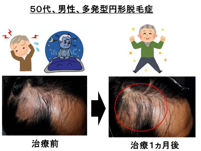 円形脱毛症　病院
